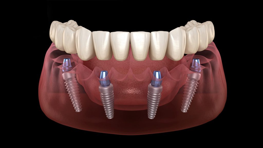 all on four implant